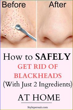 You can easily get rid of these blackheads by using natural or home remedies for blackhead treatment. Click to read How to get rid of blackheads diy| The best blackheads removal on nose| get rid of blackhads on face| get rid of blackheads on nose| how to get rid of blackheads naturally ... Natural Blackhead Remover, Remedies For Blackheads, Reverse Wrinkles, Soothing Face Mask, Remove Blackheads From Nose, How To Remove Blackheads, Overnight Skin Care, Blackhead Remover Diy