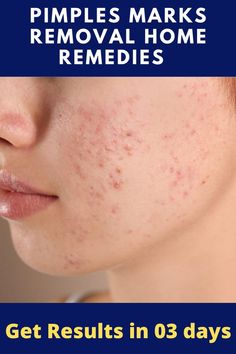 acne and pimples How To Remove Pimples In One Day, Pimple Marks Removal Homemade, Pimples Remove Tips For Girl, Pimple Scar Removal, Rid Of Acne Overnight, Eye Stye Remedies, Get Rid Of Acne Overnight