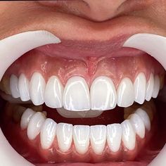 Composite Veneers Teeth, Perfect Teeth Smile, Pretty Teeth, Composite Veneers, Veneers Teeth, Beauty Procedures