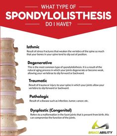 What type of spondylolisthesis do I have? There are five different types of spondylolisthesis: isthmic, degenerative, traumatic, pathologic, & dysplastic. Read more to understand the symptoms of this common condition & the underlying causes behind it. | BraceAbility Sciatic Exercises, Spinal Degeneration, Chronic Back Pain, Cervical Spondylosis, Piriformis Syndrome, Spine Surgery, Nerve Pain Relief, Nerve Pain