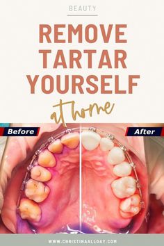 Professional dental care is the only fully effective way to remove plaque and tartar from your teeth, but you can... Tartar Removal, Plaque Removal, Teeth Health, Gum Care, Oral Care Routine, Receding Gums, The Dentist, Natural Teeth Whitening, Teeth Care