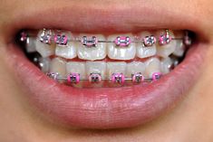 Black Braces Teeth, Hot Pink Braces, Braces Journey, Braces Transformation, Black Braces