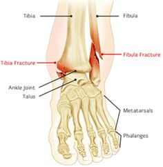 Fractured Ankle Recovery, Broken Ankle Recovery Tips, Ankle Fracture Recovery, Ankle Break, Broken Fibula, Fractured Ankle, Leg Fracture, Ankle Cast, Ankle Workout