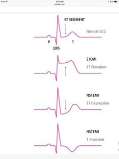 Myocardial Infarct, Cath Lab Nursing, Paramedic School, Medical School Life, Medical Student Study