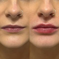 Lip Filler Inspiration Natural, Small Lips Model, Lip Filler Shape Ideas Russian, Big Upper Lip, M Shaped Lips With Filler, Sculptra Aesthetic, Lip Filler Inspo 0.5ml, Skin Fillers, 0.5 Ml Lip Filler Before And After