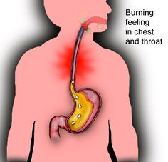 Stop Acid Reflux, Reflux Diet, Heart Burn Remedy, Acid Reflux Diet, Reflux Symptoms, Reflux Disease, Stomach Acid, Medical Prescription