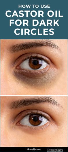 Castor Oil For Eyes, Reduce Eye Bags, Dark Circle Remedies, Dark Circles Around Eyes, Dark Eye Circles, Eye Cream For Dark Circles, Remove Dark Circles, Dark Circles Under Eyes