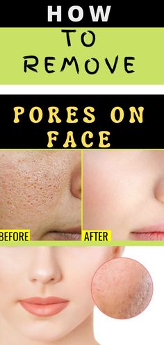 how to get rid of acne dark spots on face
how to get rid of acne scars
how to get rid of open pores
how to get rid of open pores on face
how to get rid of open pores naturally
how to get rid of open pores on nose
how to get rid of pores on face
how to get rid of pores on nose
how to remove pores
how to remove pores on face
how to remove pores on nose
how to remove large pores on face
get rid of large pores on face
get rid of large pores on face remedies
remove pores on face remedies Big Pores On Face, Minimize Pores Naturally, Face Mapping Acne, Blind Pimple, Pimples Under The Skin