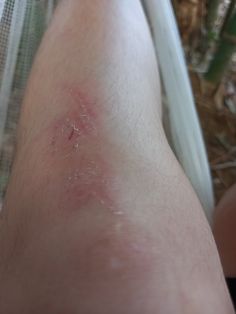 a person's leg with red spots on it and a white object in the background