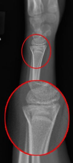 an x - ray shows the knee with two red circles around it