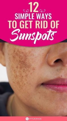 Brown Spots Removal, Sun Damaged Skin