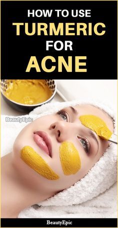 how to use turmeric for acne Skincare Acne, Acne Face Wash, Natural Acne, Home Remedies For Acne, How To Get Rid Of Pimples, Treat Acne, Acne Scar Removal, Cystic Acne