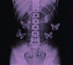 an x - ray image of a man with butterflies on his back