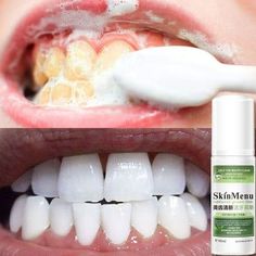 Pressing Type Mousse Toothpaste Foam, Whitening Toothpaste Ultra-fine Mousse Foam, Deep Cleaning Gums Fresh Teeth Whitening Oral Hygiene Removes Plaque Stains Description: 1.Ingredients: Tea extract, peppermint extract, ascorbic acid (vitamin C). 2.360-degree care of the oral cavity, mild and non-irritating, care for the gums, bright teeth. 3.Plant extracts, help to break down the pigmentation on the surface of the teeth, block pigmentation, keep the teeth bright and white. 4.Green tea taste, ca Baking Soda Toothpaste, Plaque Teeth, Tooth Whitening, Teeth Whitening Remedies, Teeth Whitening Diy, Stained Teeth, Natural Teeth Whitening, Tea Tasting, Natural Teeth