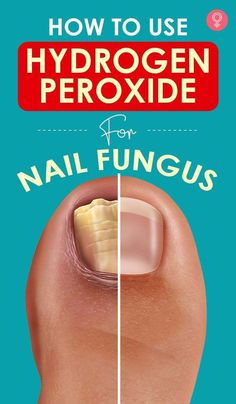 Toenail Health, Toenail Fungal Infection, Nail Remedies, Peroxide Uses, Hydrogen Peroxide Uses, Toenail Fungus Remedies, Nail Fungus Remedy, Nail Infection, Fungal Nail