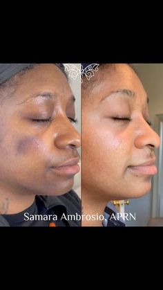 Hyperpigmentation Around Eyes, Skin Histology, Hyperpigmentation Black Skin, When To Plant Vegetables, Treating Hyperpigmentation, Dark Skin Beauty, Acne Marks