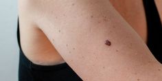 3 Types of Skin Cancer That Should Be on Everyone's Radar Cold Or Allergies, Basal Cell, Persistent Cough, Squamous Cell, Types Of Skin, Types Of Cancers, Beauty Life, A Word