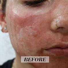 Laser Acne Scar Removal, Before And After Acne, Popping Pimples, Acne Laser, Fractional Laser, Post Inflammatory Hyperpigmentation, Laser Resurfacing, Skin Science, Acne Scar Removal