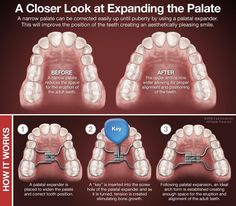 How palatal expanders work Palate Expander, Dental Posts, Orthodontic Appliances, Dental Anatomy, Dental Fun, Dental Braces