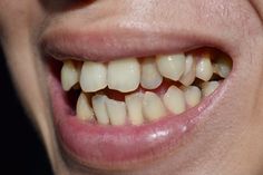 a close up of a person's mouth with missing teeth and gums on it