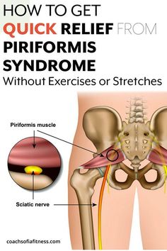 If you're in pain from piriformis syndrome, stop the exercises and try these 7 tips to help you get quick relief so you can feel better quick Posture Tips, Sciatic Nerve Relief, Sciatica Symptoms, Personalized Workout Plan