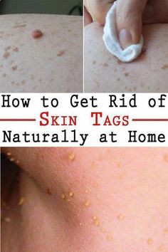 Just Rub Your Skin With This Spice Excema Remedies, What Causes Warts, Warts On Hands, Warts On Face, Lifting Facial, Get Rid Of Warts, Skin Tags, Cold Sores Remedies, Natural Cold Remedies