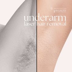 Laser Away Underarm Hair 🪒  Experience the ease of underarm care with our laser hair removal treatments! 🌟 Say farewell to razors and wax strips and hello to lasting smoothness.  🔹 Swift sessions 🔹 Long-term results 🔹 Comfortable experience 🔹 Reduced ingrown hairs  Lift your arms with confidence every day!   Book now:⁣ 💚 VS MedSpa Laser & Skin Clinic in Toronto:⁣  🌎https://www.versuslaser.com/ ⁣ Laser Hair Removal Sideburns, Laser Hair Removal Underarms, Laser Hair Removal Benefits, Laser Hair Removal Post Ideas, Laser Hair Removal Instagram Post, Laser Hair Removal Marketing Ideas, Laser Hair Removal Post, Laser Hair Removal Marketing, Laser Hair Removal Aesthetic