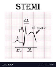 the stemi diagram on a white background