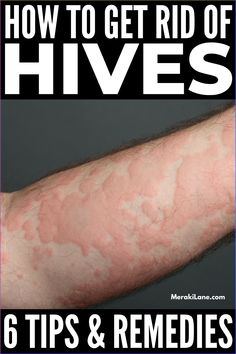 Hives are itchy, irritating and overall no fun. If you want to know how to get rid of hives, we’ve compiled 6 natural remedies for relief. How To Treat Hives, Natural Remedies For Hives, Remedies For Hives, Skin Rash On Face, Home Remedies For Hives, Skin Rashes Pictures, Hives Rash, Allergy Hives, Home Remedies For Rashes