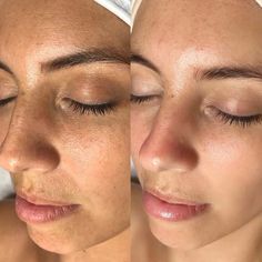 Skin Before And After, Hydra Facial Before And After, Hydrafacial Before And After, Facial Benefits, Remove Skin Tags Naturally, Skin Poster, Oxygen Facial, Microcurrent Facial