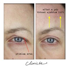 Pro Thread Lift Before And After, Pdo Thread Lift Eyebrow, Pdo Threads Under Eyes, Hooded Eyes Surgery, Thread Face Lift Before And After, Botox Eye Lift, Botox For Hooded Eyes, Hooded Eye Surgery Before And After, Pdo Threads Before And After