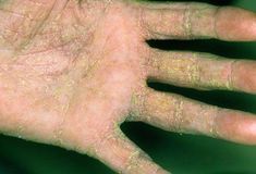 See scabies skin rashes, symptoms (night itching), treatments, and home care in this WebMD slideshow. Pictures show the itch mite, how it spreads, who gets scabies, and how to get rid of it. Slideshow Pictures, Remedies For Dry Mouth, Home Remedies For Allergies, Home Remedies For Warts, Oily Skin Remedy, Warts Remedy, Natural Remedies For Migraines, Home Remedies For Skin, Skin Rashes