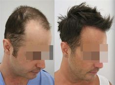 Turkey Hair Transplant Cost Package. There are any references about Turkey Hair Transplant Cost Package in here. you can look below. I hope this article about Turkey Hair Transplant Cost Package can be useful for you. Please remember that this article is for reference purposes only. #turkey #hair #transplant #cost #package Hair Transplant Women, Hair Implants, Prp Hair, Hair Transplant Cost, Hair Transplant Results, Chemo Hair, Static Hair, Fue Hair Transplant, Hair Transplant Surgery