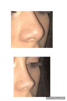 Ideal Facial Features, Nose Job Tape Aesthetic, Natural Looking Nose Job, Rib Removal Surgery Before And After, Upturn Nose, Subtle Nose Job, Nose Job Inspiration Natural