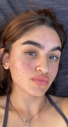 Girl With Acne, Estilo Kylie Jenner, Natural Acne Remedies, Normal Body, Bare Face, Face Acne, Bare Beauty, Pretty Skin, Raw Beauty