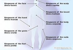 See an illustration picture of and learn about types of ringworm, fungal skin infections, in the eMedicineHealth Image Collection Gallery. Medical Diagrams, Fungal Rash, Lipoma Removal, Tinea Pedis, Fungal Infection Skin, Illustration Picture, Sweat Gland, Picture Illustration, Skin Diseases