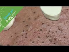 Make Your Day Relaxing with Windy Spa 6#50 - YouTube Popping Blackheads Youtube Videos, Blackheads Removal Cream, Nose Pimples, Squeezing Blackheads, Pimple Extraction, Blackheads On Face, Cystic Pimple, Blackhead Remover Diy, Zit Popping Videos