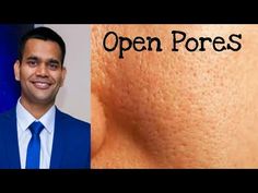 How To Get Rid Of Open Pores Permanently | open pores on face Treatment - YouTube How To Close Large Pores On Face, Close Open Pores The Face, Remedies For Open Pores On Face, Reduce Open Pores On Face, How To Remove Open Pores, How To Reduce Open Pores On Face, Open Pors On Face, Remedy For Open Pores On Face, Pores On Face How To Get Rid Of At Home