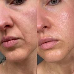 Eye & Mouth Wrinkle Patches | Natural Botox Alternative Botox Around Mouth, Botox Eyes, Face Lift Exercises, Liquid Facelift, Wrinkle Patches, Mouth Wrinkles, Natural Botox, Muscles Of The Face, Marionette Lines