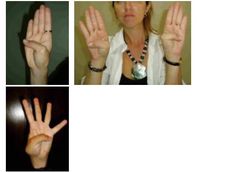 Hands signs in Marfan syndrome: thin fingers, long hand shape & hypermobility! Description from pinterest.com. I searched for this on bing.com/images Eds Facts, Ehlers Danlos Syndrome Types, Complex Migraine, Neurocardiogenic Syncope, Ehlers Danlos Syndrome Awareness, Chiari Malformation, Musculoskeletal Pain, Ehlers Danlos, Connective Tissue