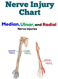 Nerve Injury/Dysfunction Chart for Median, Ulnar, and Radial Nerves **Included in the Anatomy & Kinesiology Study Guide BUNDLE** Includes: Level of Injury, Description of the Dysfunction, Visual, Muscles Acting, and Muscles Lost for the following injuries... -High Median Nerve Injury -High Median Nerve AND Low Median Nerve Injury  -Low Median Nerve Injury -High Ulnar Nerve Injury  -High Ulnar Nerve AND Low Ulnar Nerve Injury  -Low Ulnar Nerve  -Radial Nerve Injury - Proximal Humerus Injury -Radi Physiotherapy Notes, Nerve Injury, Stretch Therapy, Nerve Anatomy, Radial Nerve, Rehab Exercises, Basic Anatomy, Ulnar Nerve