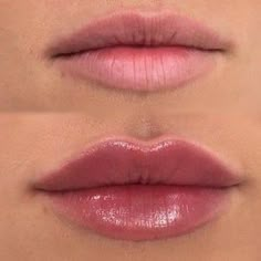 Lip Fillers Juvederm