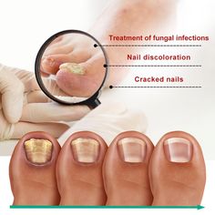 Find many great new & used options and get the best deals for nail Essence Anti Paronychia Onychomycosis Care Toenail Nail Care for Nail at the best online prices at eBay! Free delivery for many products! Nails Without Nail Polish, Remove Nail Polish, Nail Discoloration, Nail Serum, Nail Problems, Hand And Foot Care, Ingrown Nail, Fungal Nail, Nail Repair