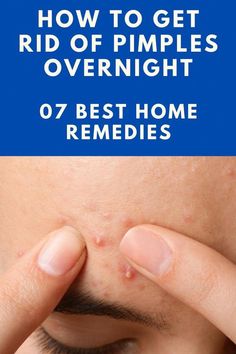 Face Pimples Remedies, Remove Pimples Overnight, Get Rid Of Pimples Overnight, Rid Of Pimples Overnight, Painful Pimple, Home Remedies For Pimples, Blind Pimple, Get Rid Of Pimples, Rid Of Pimples