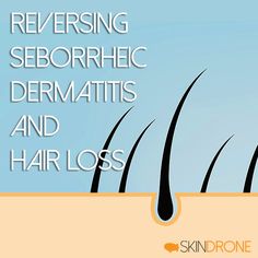 This article examines the connection between seborrheic dermatitis and hair loss. Why it occurs, how it can be reversed and how growth can be accelerated. Baldness Solutions, Thick Hair Remedies, Improve Hair Growth, Male Pattern Baldness, Pattern Baldness, Hair Restoration, For Hair, Natural Hair, Hair Hair