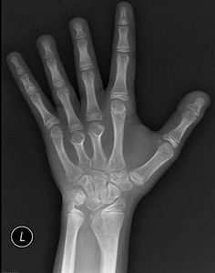 an x - ray image of the left hand and wrist with bones labeled below it