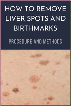 Liver spot or birthmark - what is the difference? How do I keep an eye on the pigment spots to avoid getting skin cancer? And what should I do if they change and the dermatologist wants to remove them? Red Spots On Face, Red Skin Spots, What Causes Pimples, Liver Spot, Moles On Face, Freckle Remover, Age Spot Removal, Brown Spots On Skin, Diy Beauty Treatments