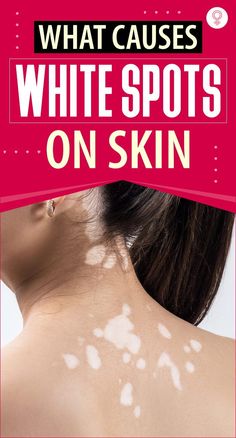 Spots On Skin, Clogged Arteries, Tips Skincare, White Patches