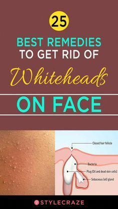 Are you looking for the best ways to get rid of whiteheads? Click here and check out the best at-home remedies and over-the-counter treatment options. Home Remedies, Good Things