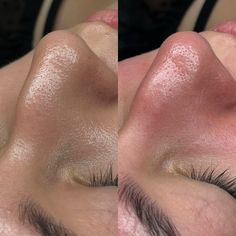 Before & after acne facial. We focused on extractions on the nose, chin and decongesting her skin to prevent any further blemishes, and clogged pores. #oremlashes #utahlashes #lindonlashes #provolashes #lashartist #lashtech #lashes #utahcountylashes #utahlashartist #esthetician #esthetic #utahesthetician #utah #ut #utahcountybusiness #facial #acnefacial #acnetreatment Before And After Acne, Foto Fake, Acne Facial, The Nose, Lash Artist, Clogged Pores, Esthetician, Lashes, Facial